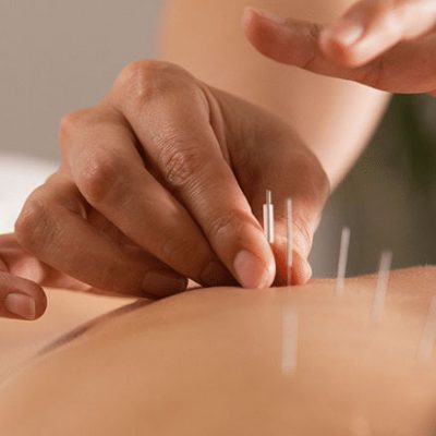 acupuncture